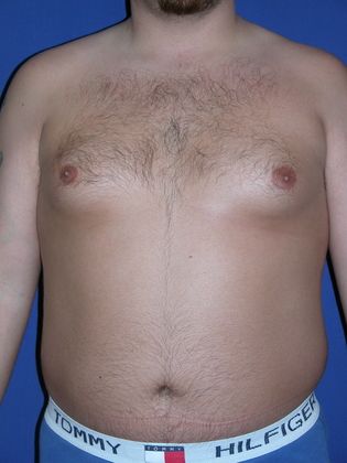 Before male breast reduction