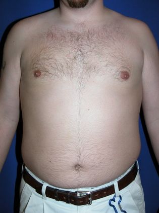 After male breast reduction